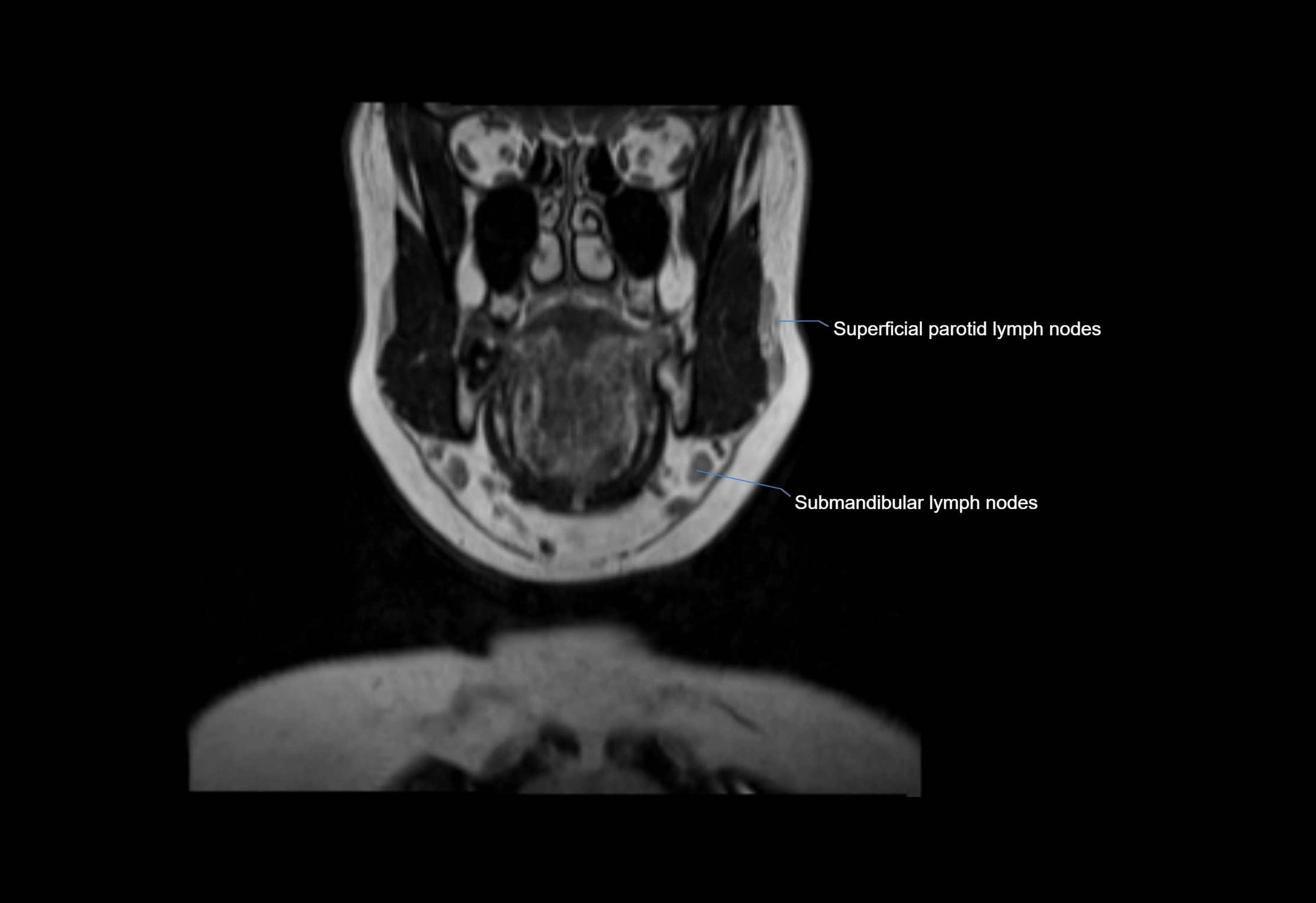 Neck coronal lymph node cross sectional MRI anatomy 3T MRI  image-img-00001-00055.webp